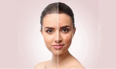 Women And People With Darker Skin Suffer From The Psychological Effects of ACNE