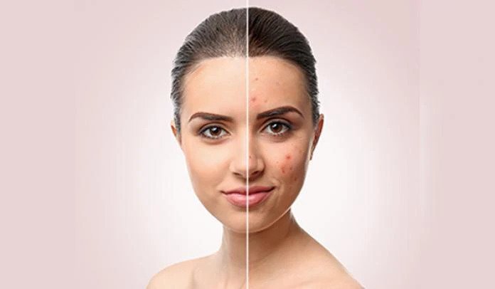 Pharmacy News Image Women And People With Darker Skin Suffer From The Psychological Effects of ACNE